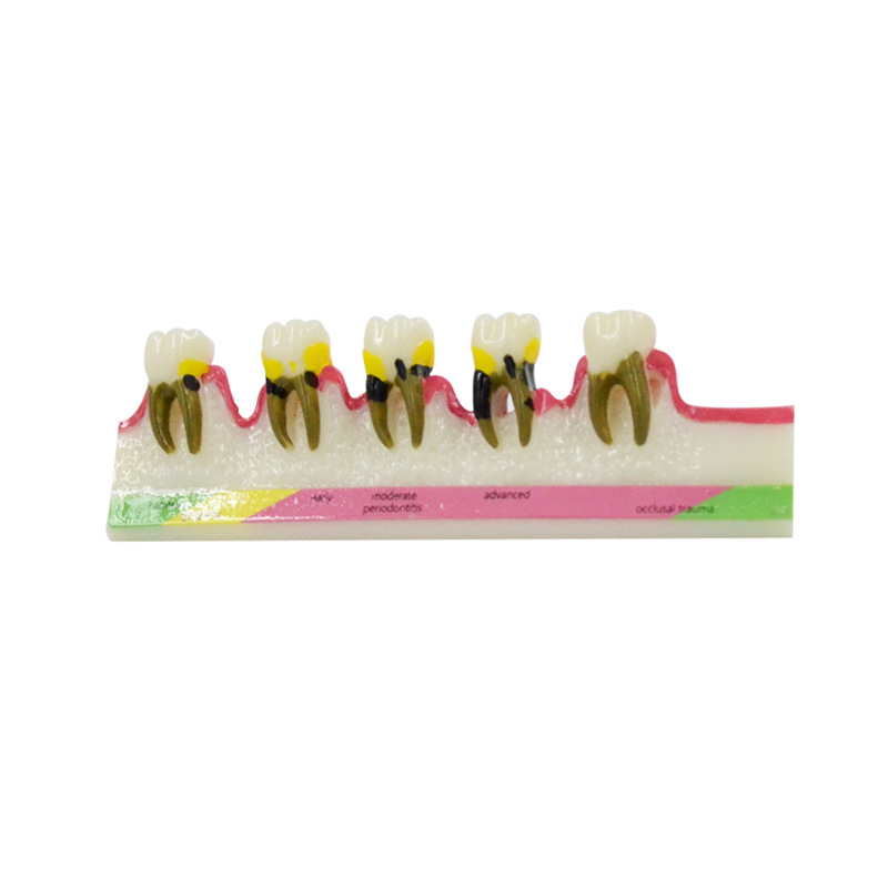 Periodontal Disease Model Dent - Medical Lab Study recension och pris