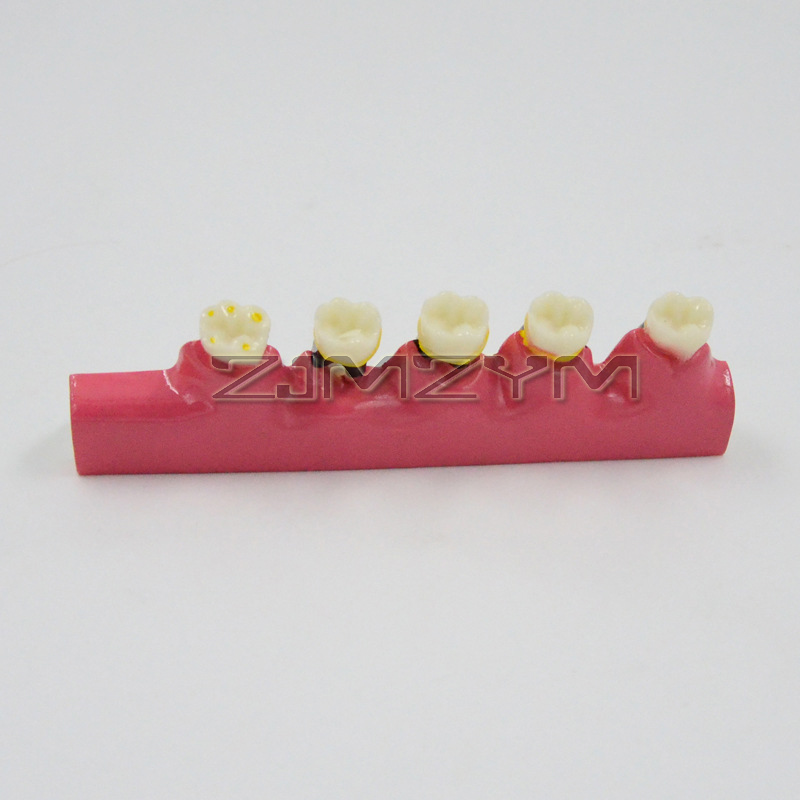 Periodontal Disease Model Dent - Medical Lab Study recension och pris
