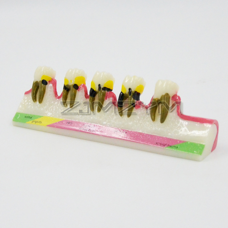 Periodontal Disease Model Dent - Medical Lab Study recension och pris
