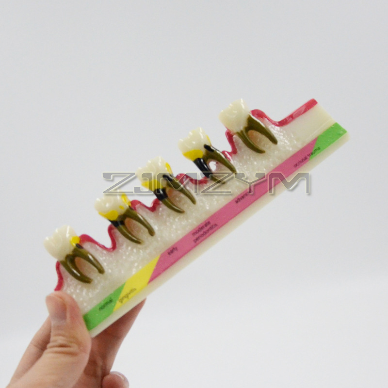Periodontal Disease Model Dent - Medical Lab Study recension och pris